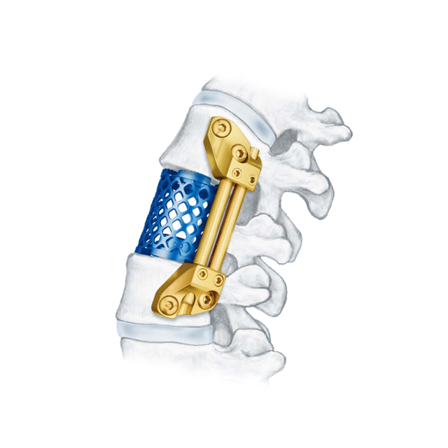 Cage en maille de titane