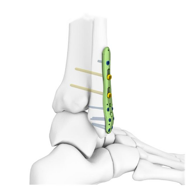 Plaque de verrouillage fibulaire distale