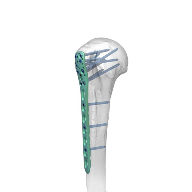 Plaque de verrouillage humérale proximale