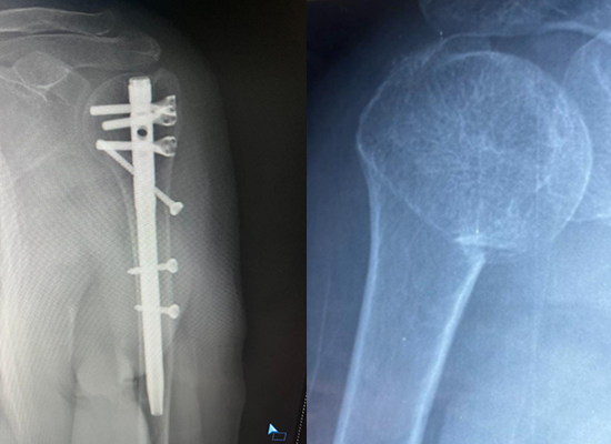 fracture-hum&eacute;rale-postop&eacute;ratoire-xray-czmeditech