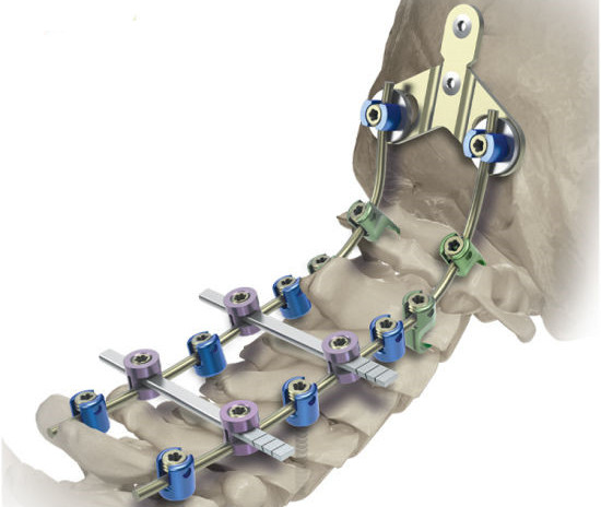 Post&eacute;rieur-Cervical-Vertebra-Fixation-Pedicle-Screw_副本_副本