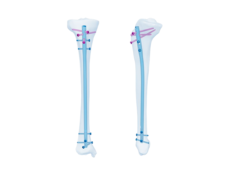 Clou intramédullaire tibial expert : amélioration des chirurgies orthopédiques