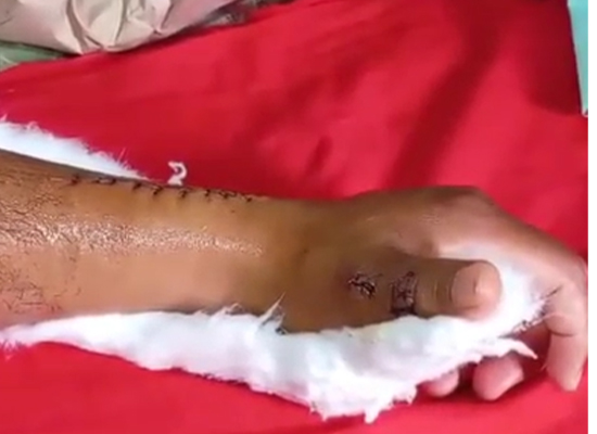 r&eacute;cup&eacute;ration-postop&eacute;ratoire-mouvement-du-pouce-m&eacute;decine-sportive-czmeditech 