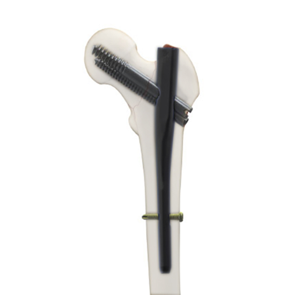 Clou TriGen InterTAN