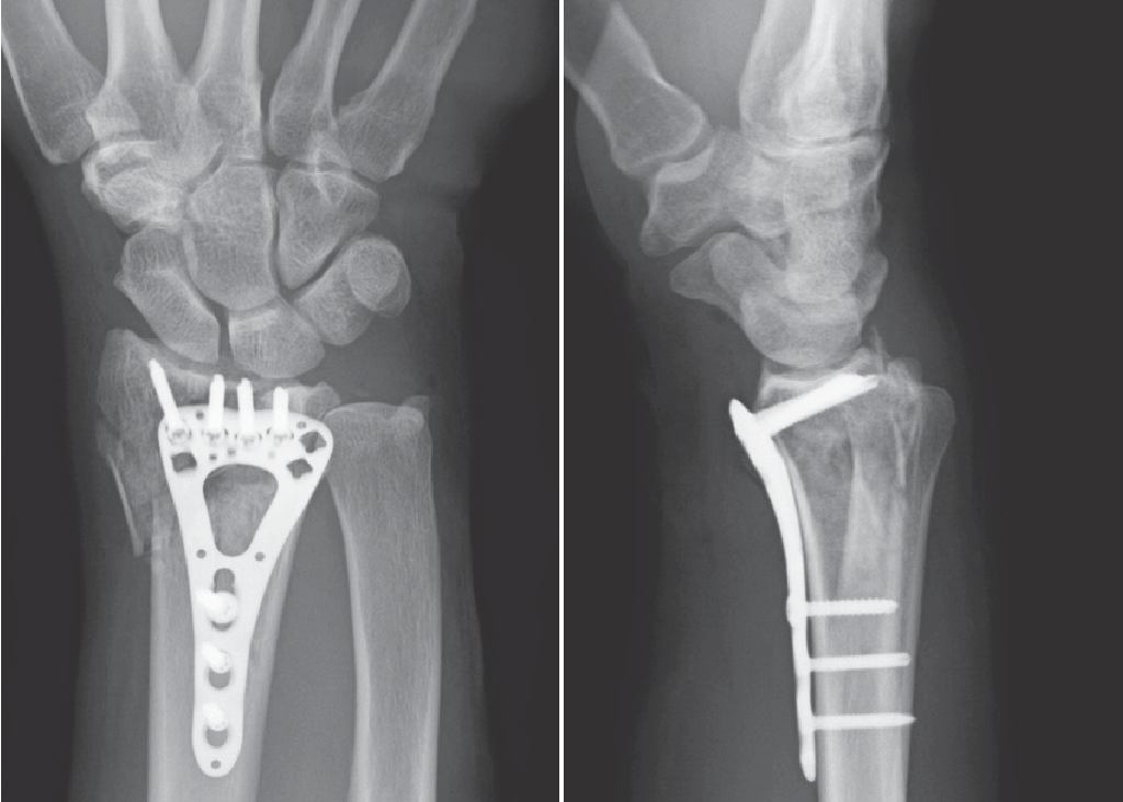 Connaissez-vous l'histoire de la plaque de verrouillage ?
