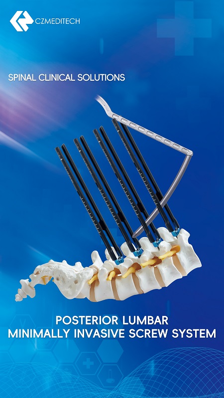 Syst&egrave;me vis lombaire post&eacute;rieur minimalement invasif