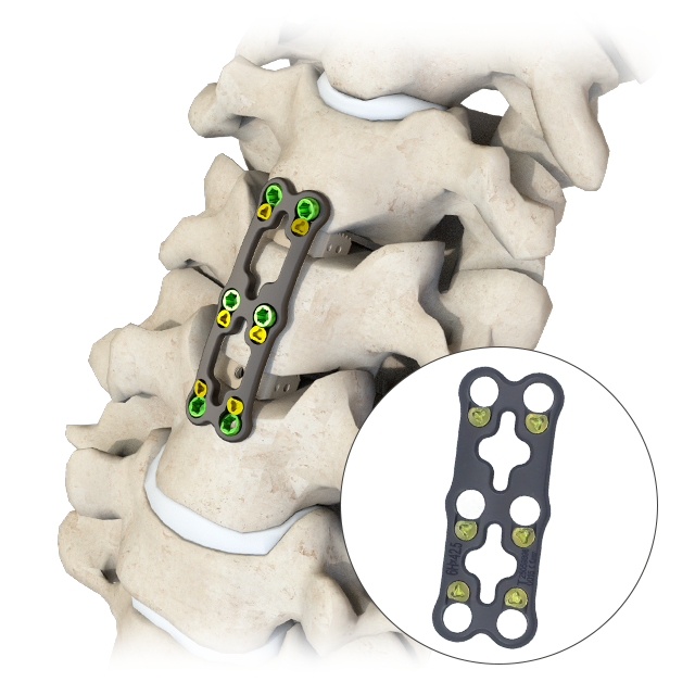 Système de fixation de la colonne cervicale antérieure