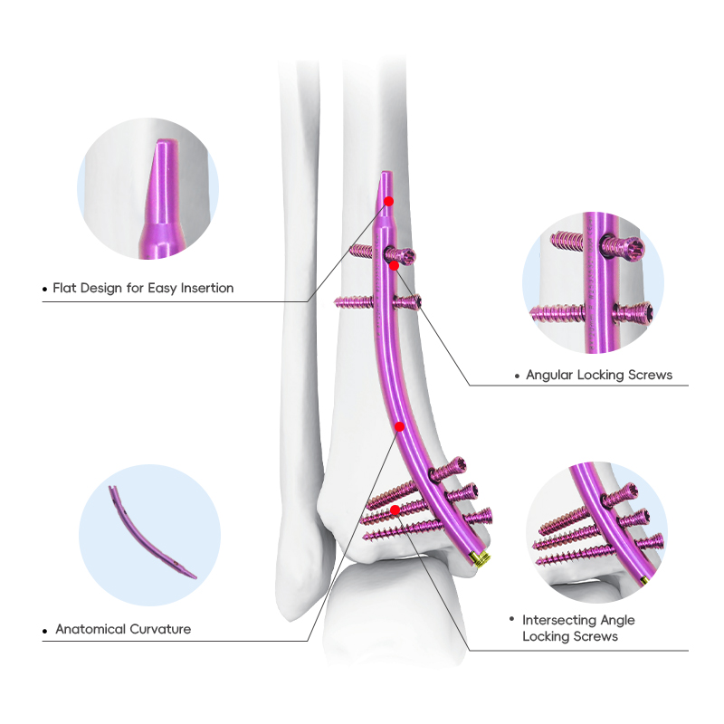 Ensemble d'instruments intramédullaire tibial distal (DTN)