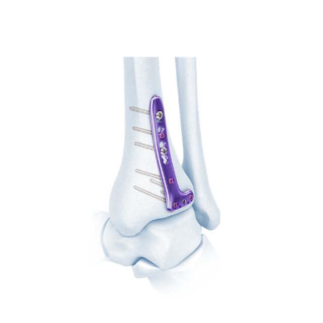 VA Distal Tibia Locking L-Plate