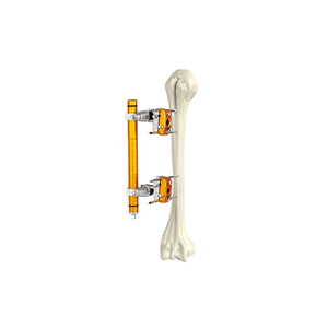 Fixateur externe humérus