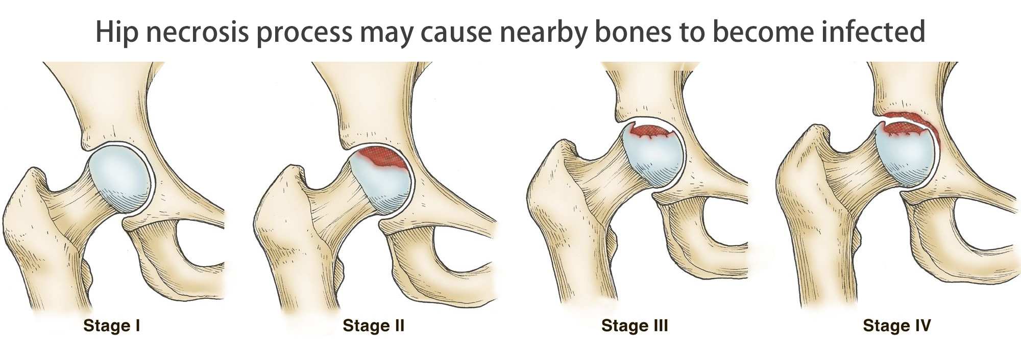 Hip necrosis process Processus de nécrose de la hanche