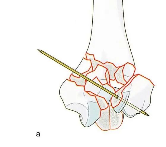 Reconstruction de la trochl&eacute;e et du capitellum
