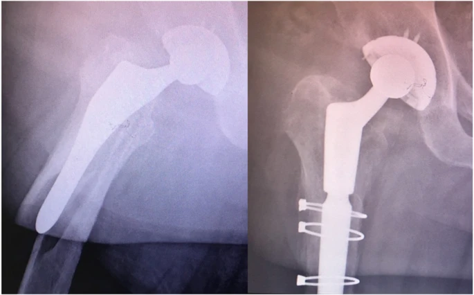 Arthroplastie et fixation par fil de cerclage pour les fractures du lambeau r&eacute;trograde.