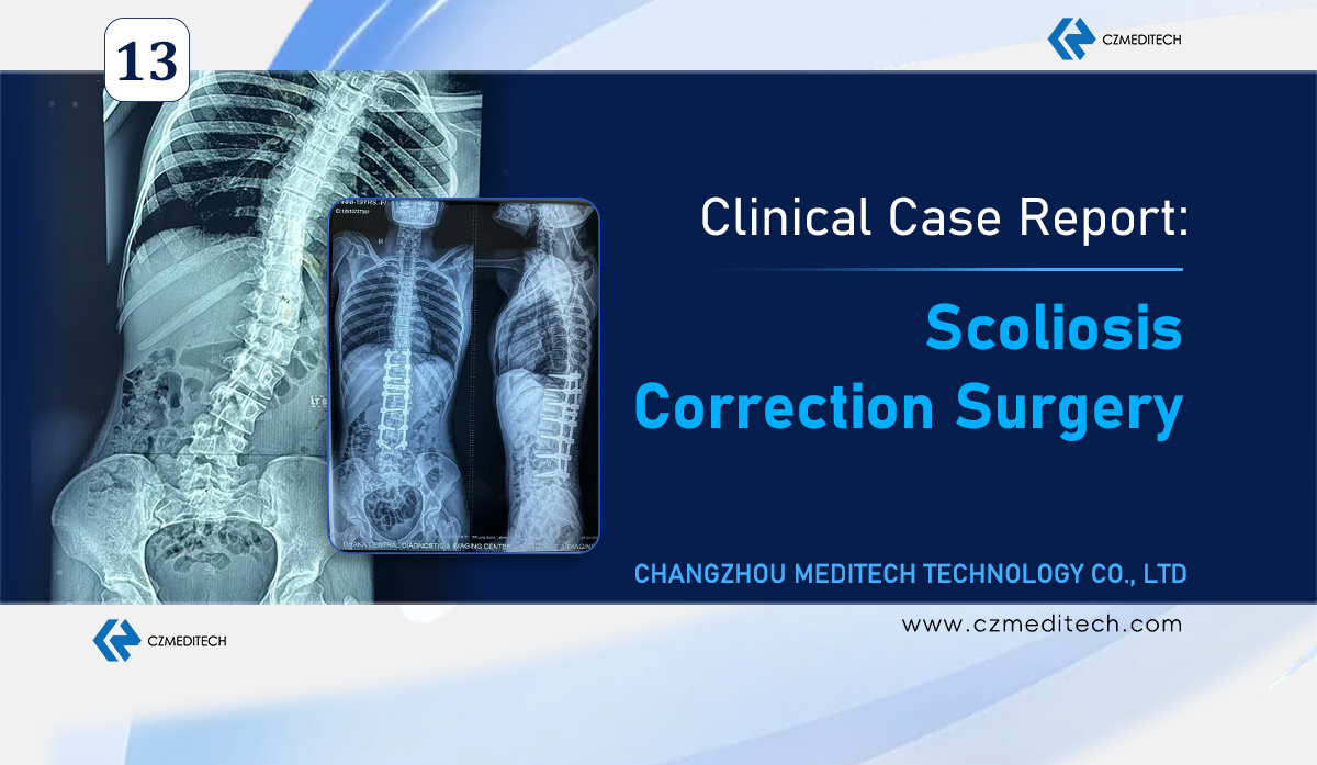 Chirurgie de correction de la scoliose au Bangladesh : système de vis pédiculaire vertébrale de 6,0 mm