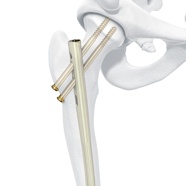 Clou de fémur