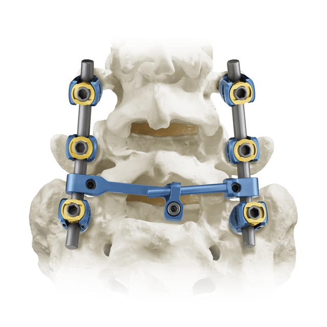 5.5 Système de vis pédiculaire spinale