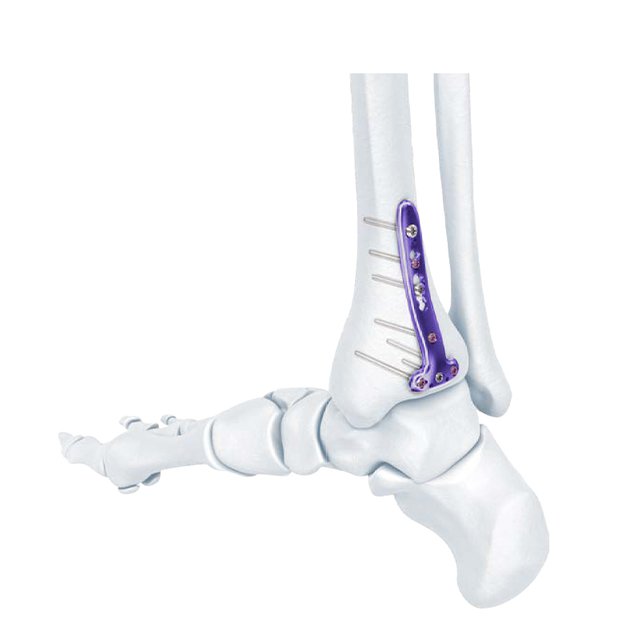 VA Distal Tibia verrouillage de la plaque T