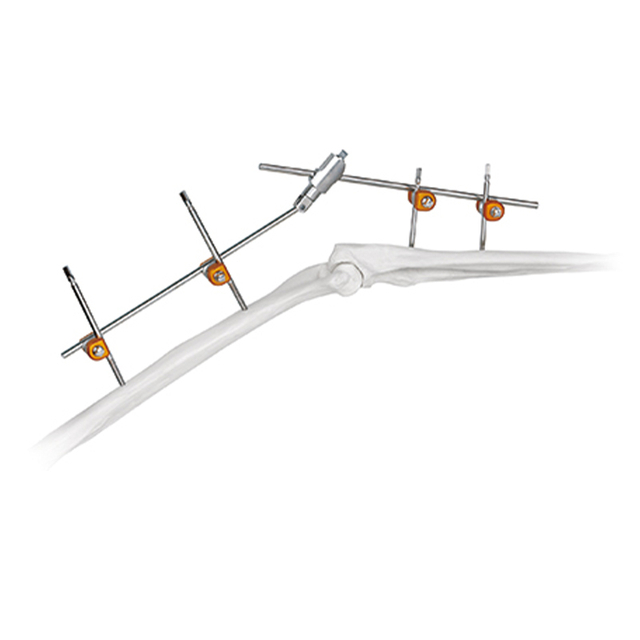 Fixateur externe conjoint du coude
