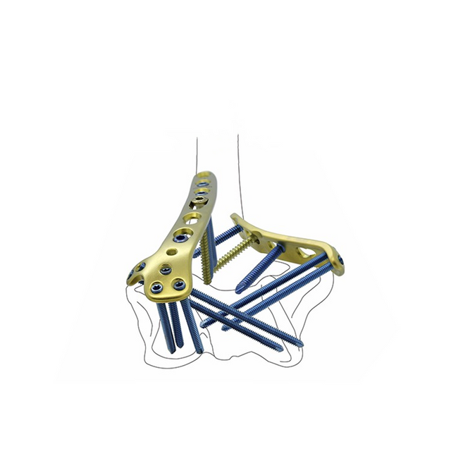 Plaque de verrouillage distale médiale humérale