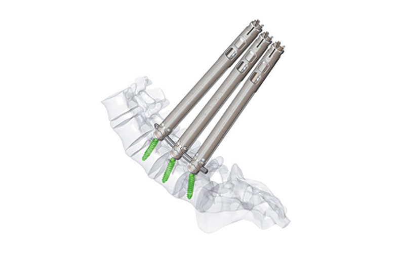 5.5-Vis-pédicale-mini-invasive