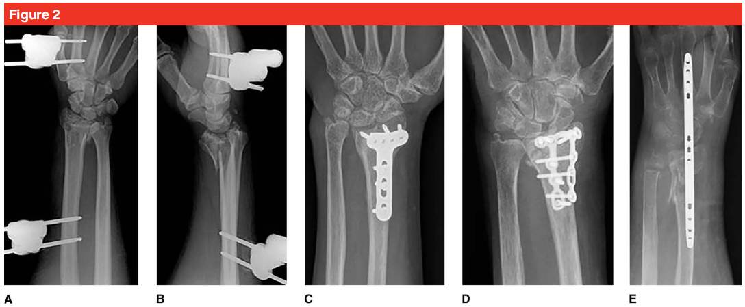 Plaque de verrouillage de la paume