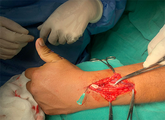 t&eacute;norraphy-technique-de-suture-tendon-du-pouce-czmeditech