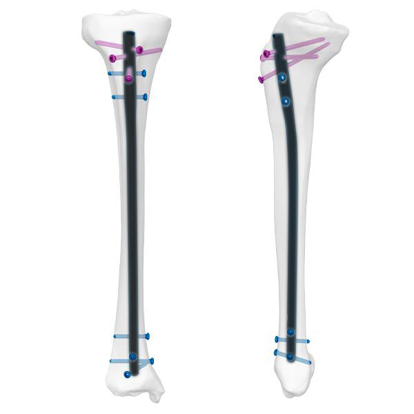 Ongle Expert Tibia