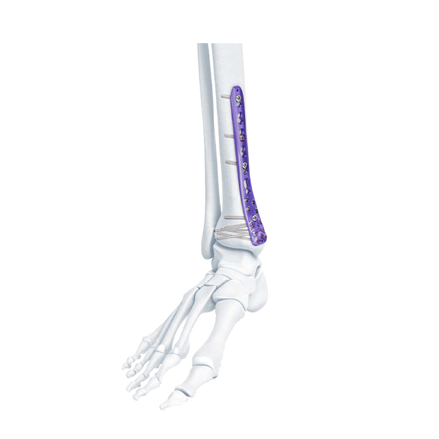 Va Distal Medial Tibia Plaque de verrouillage