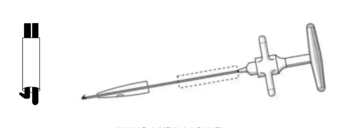 Ablation d'un clou intram&eacute;dullaire canul&eacute; cass&eacute;