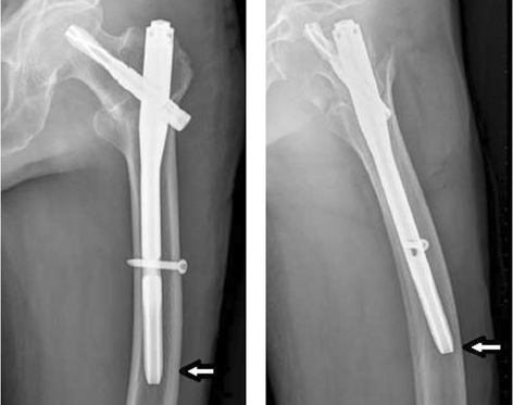 La radiographie-montre-la-pointe-du-PFNA-II-contre-la-paroi-lat&eacute;rale-chez-les-patients-&acirc;g&eacute;s-avec-un_副本