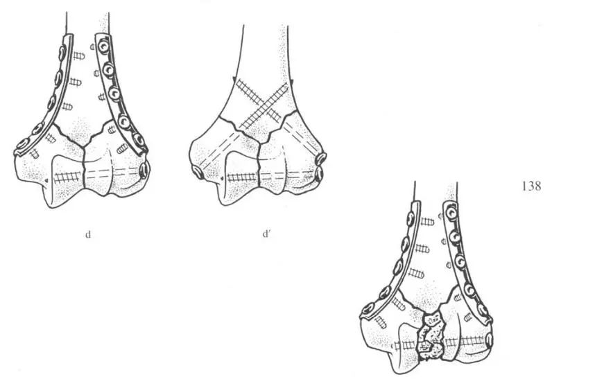 hum&eacute;rus distal