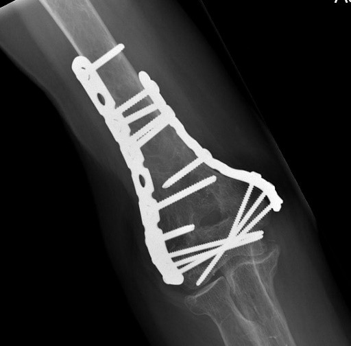 Comment réparer une fracture de l'humérus distal ?