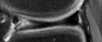 Aspect d&eacute;g&eacute;n&eacute;ratif du m&eacute;nisque