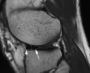 Angle g&eacute;ant itamae demi-lune