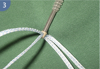 Suture en poly&eacute;thyl&egrave;ne