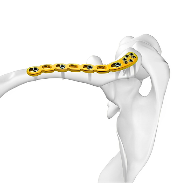 Plaque de verrouillage claviculaire distale
