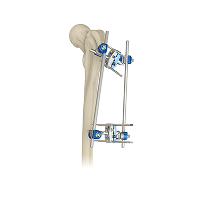 Fixateur externe du fémur proximal