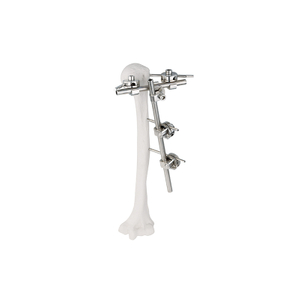 Fixateur externe du cou condylien latéral huméral