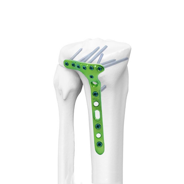 Plaque de verrouillage tibial latéral distal-II