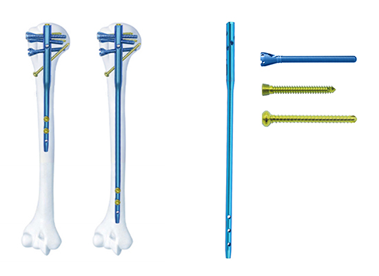 Clou intram&eacute;dullaire hum&eacute;ral multi-lock-czmeditech