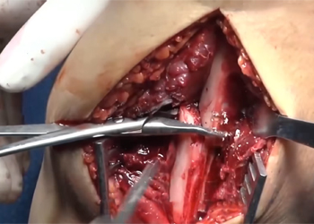 chirurgie-de-la-clavicule-orif-proc&eacute;dure-mexique-czmeditech