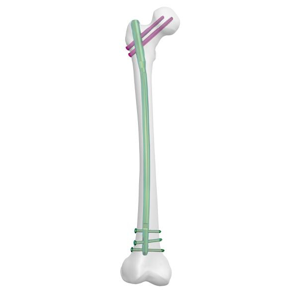 Clou fémoral expert