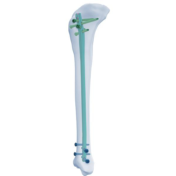 Ongle Expert Tibia