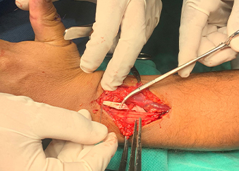 uhmwpe-suture-pour-la-r&eacute;paration-des-tendons-czmeditech 