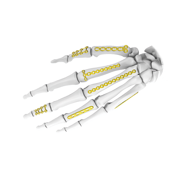 Mini plaque de verrouillage