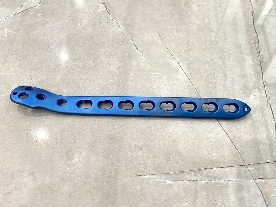 Plaque de verrouillage tibial lat&eacute;ral distal