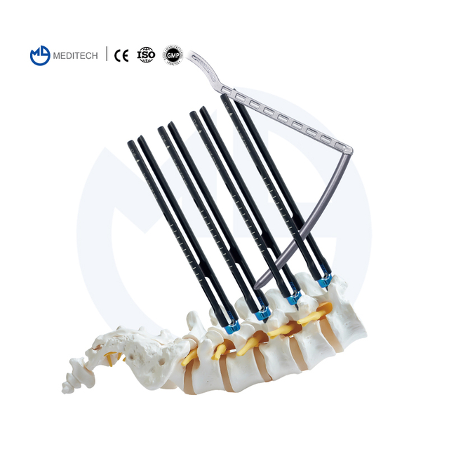 Système de vis pédiculaire spinal (système de 5,5 mm)