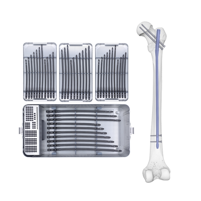 Boîte à ongles intramédullaire fémorale experte