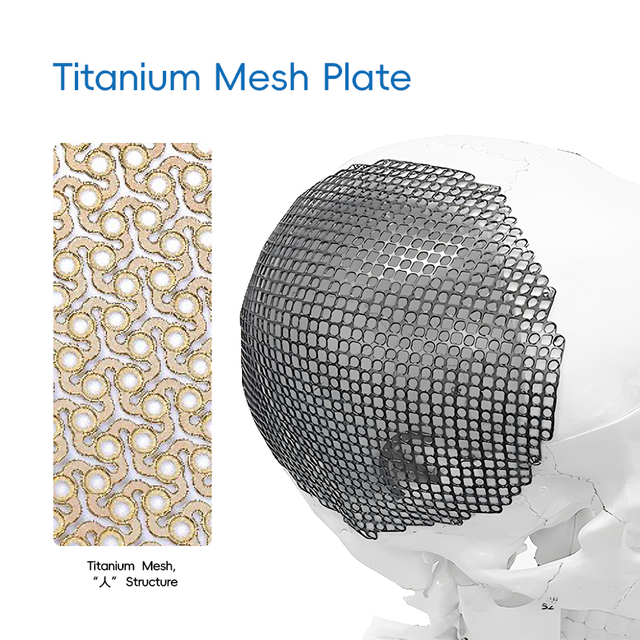 Titanium Mesh, 'λ ' Structure