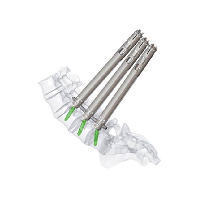 5.5 Vis pédicale mini-invasive